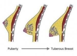 What is a Tuberous Breast Deformity? - Dr Zachary Farris