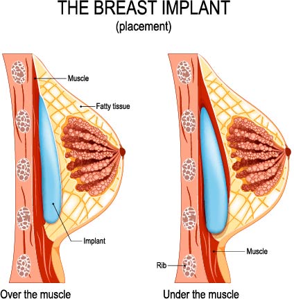 Gummy Bear Breast Implants  Anatomical Breast Implants