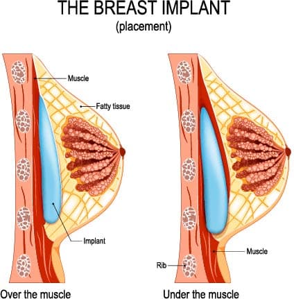 Your Simple Guide to Dual Plane Breast Augmentation