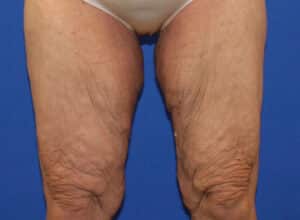 Before Image: Patient 1