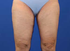 After Image: Patient 1