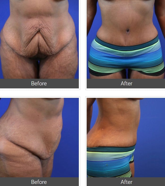 Dallas Body Plastic Surgery - Arm & Thigh Lift, Liposuction, Tummy