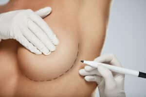 Close up of woman's breast as surgeon draws incision marks for a breast lift in Dallas