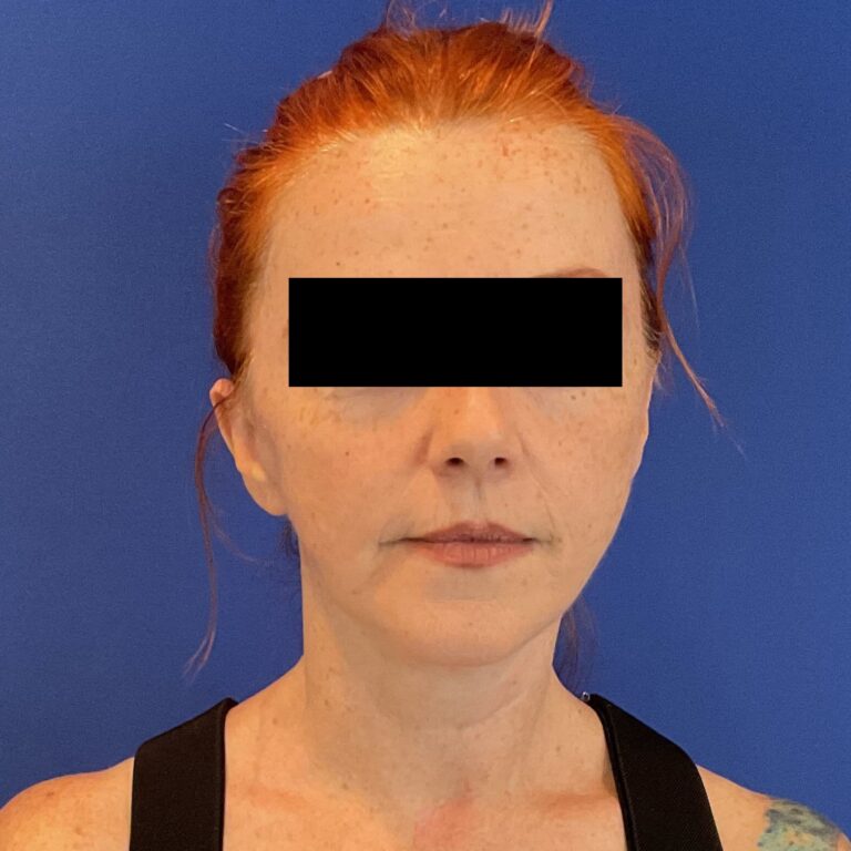 After Image: Patient Case #6767 - front