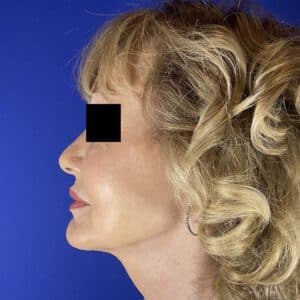 After Image: Patient Case #6846