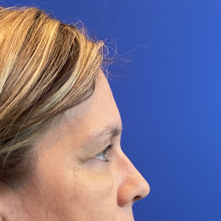 Before Image: Patient Case #6820 - right-side