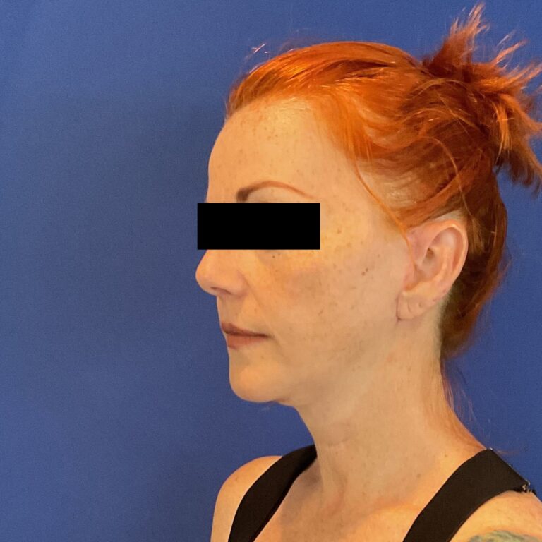 After Image: Patient Case #6767 - left-front-oblique