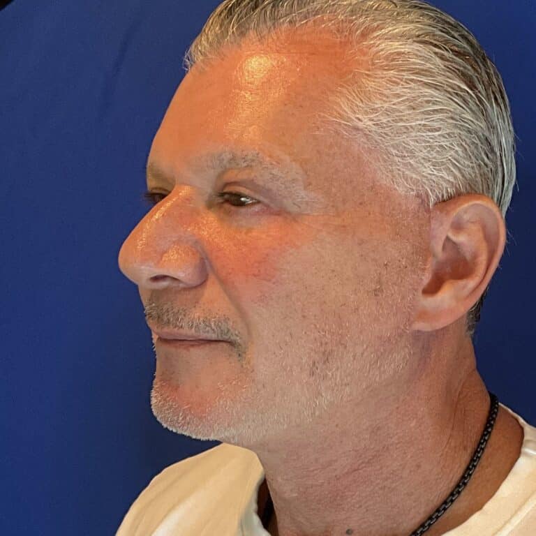 After Image: Patient Case #3641 - left-front-oblique