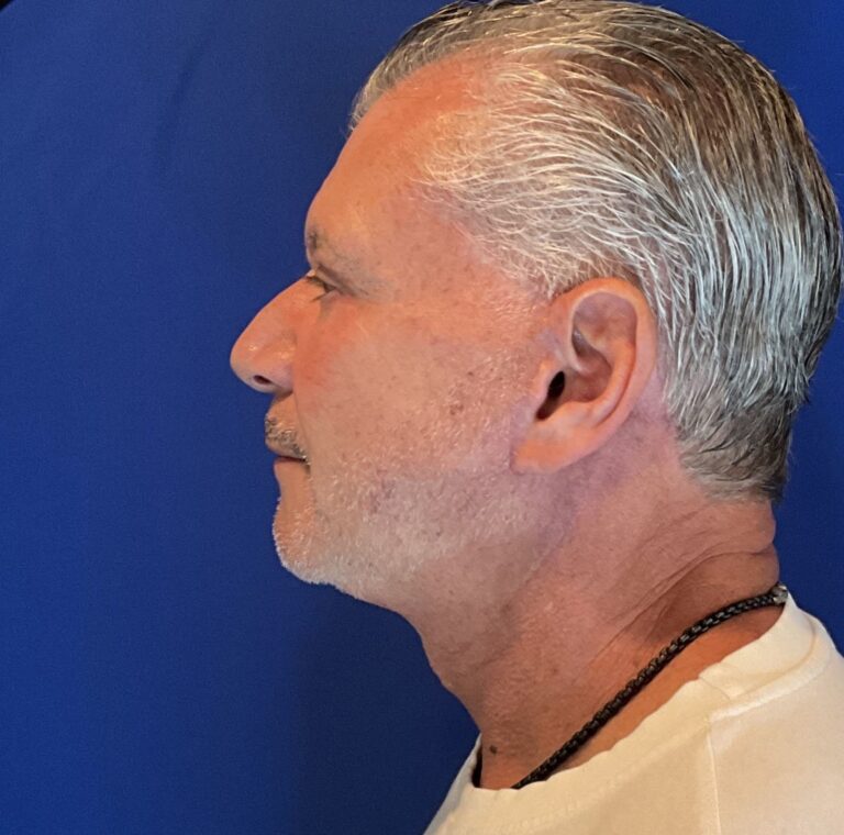 After Image: Patient Case #3641 - left-side