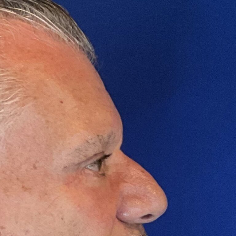 After Image: Patient Case #3531 - right-side