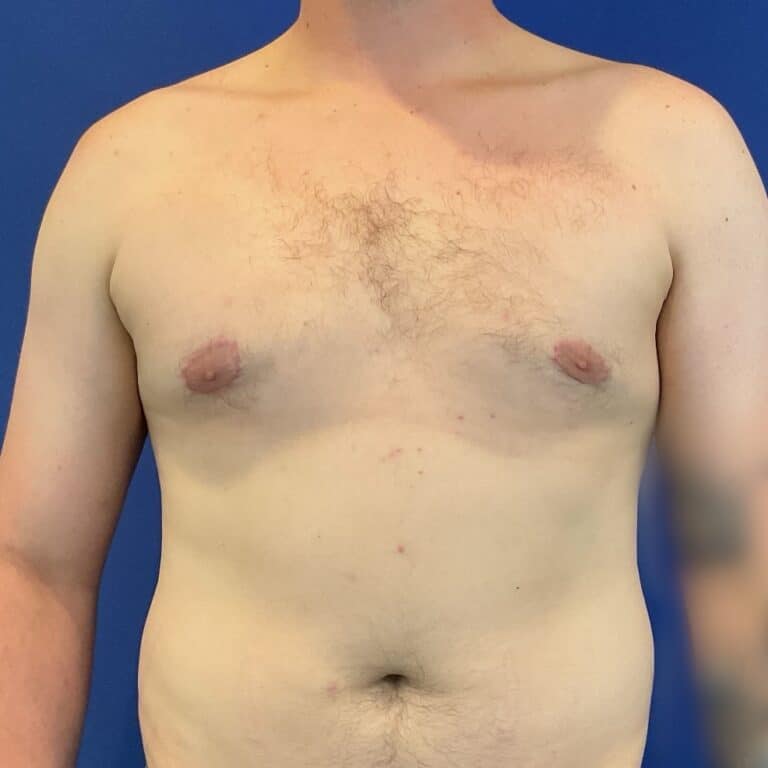 After Image: Patient Case #6754 - front