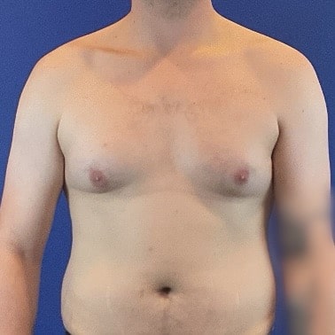 Before Image: Patient Case #6754 - front