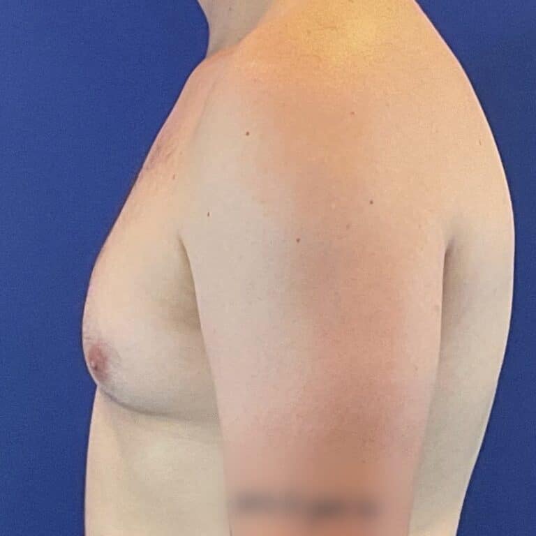 Before Image: Patient Case #6754 - front