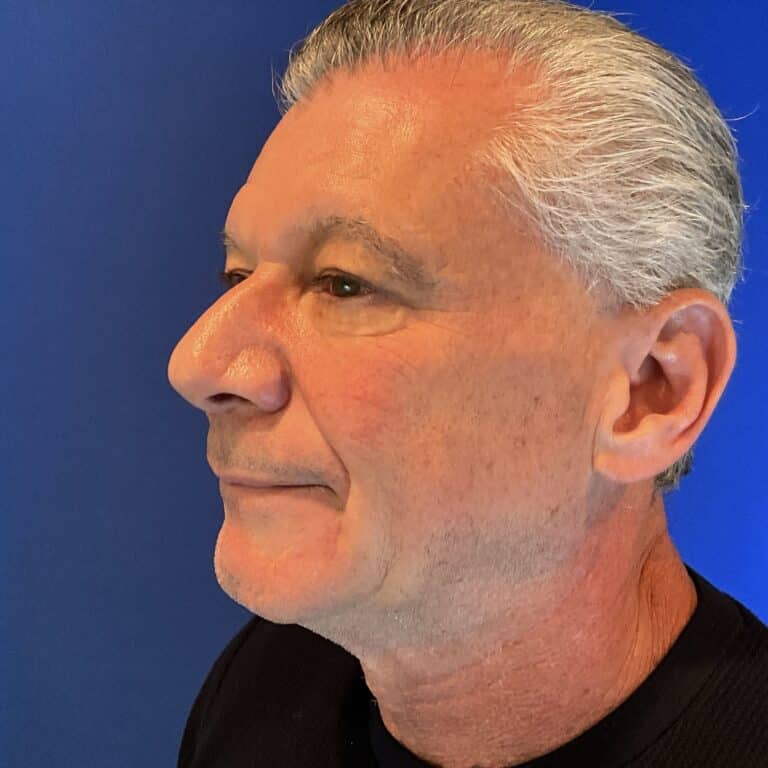 Before Image: Patient Case #3641 - left-front-oblique