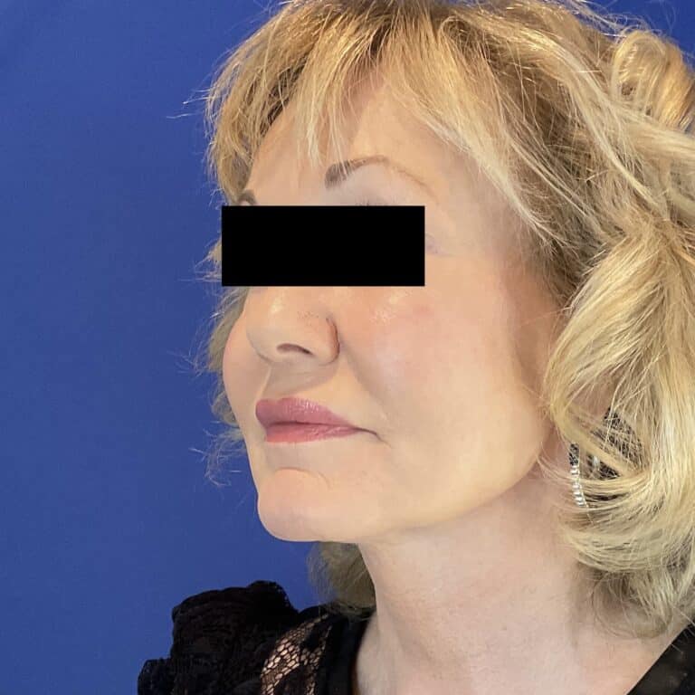 After Image: Patient Case #6846 - left-front-oblique