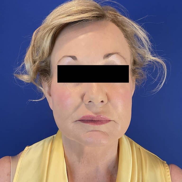 Before Image: Patient Case #6846 - front