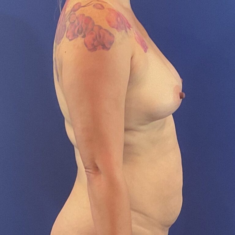 Before Image: Patient Case #6759 - front