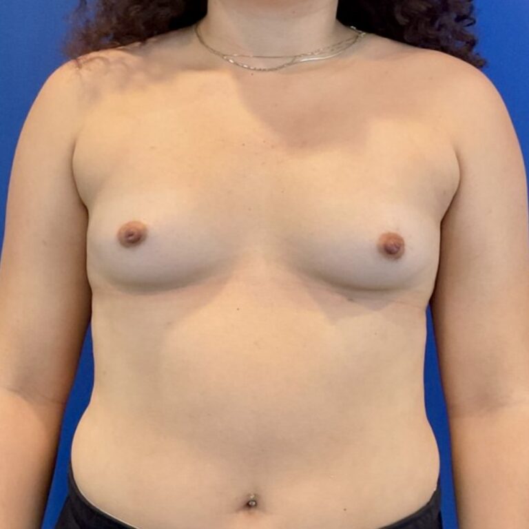 Before Image: Patient Case #6797 - front