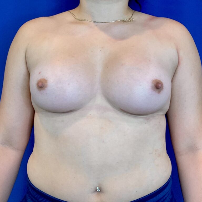 After Image: Patient Case #6797 - front