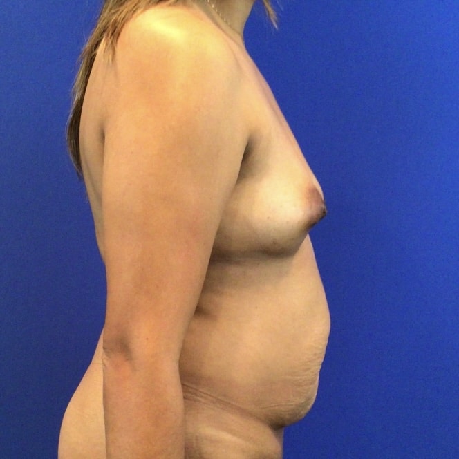 Before Image: Patient Case #6803 - right-side