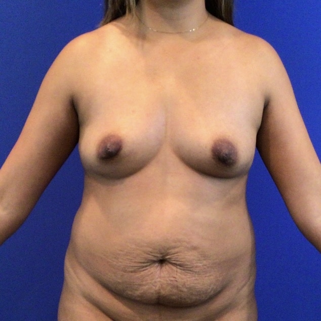 Before Image: Patient Case #6803 - front
