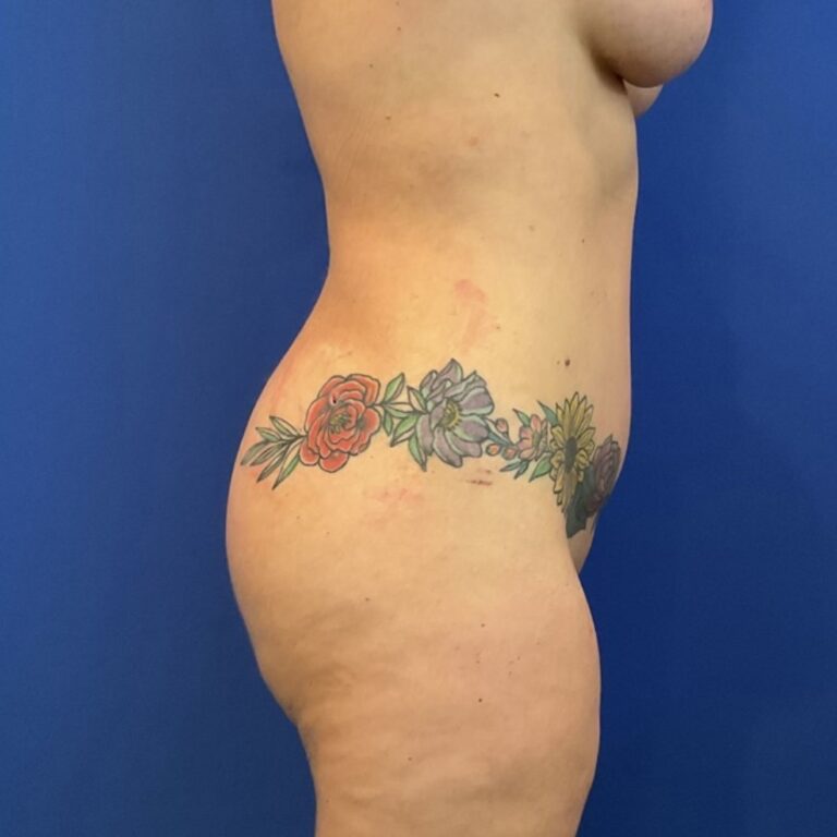 After Image: Patient Case #6856 - right-side