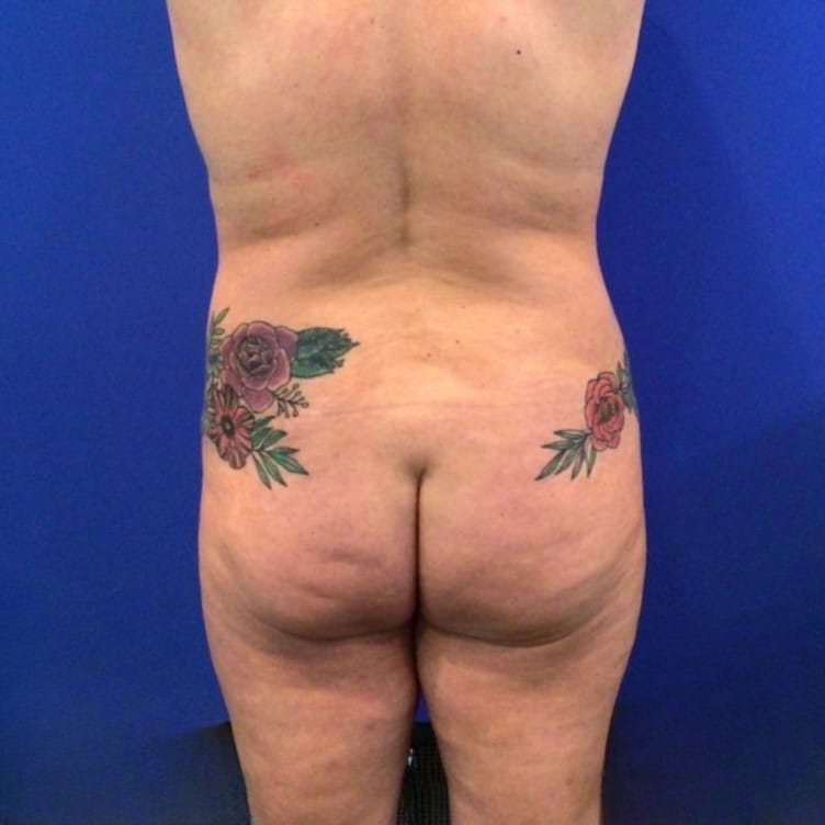 Before Image: Patient Case #6856 - back