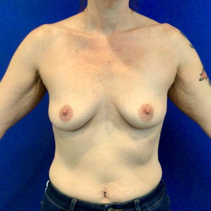 Before Image: Patient Case #6863 - front