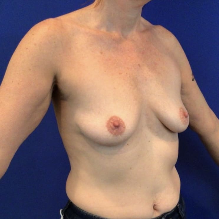 Before Image: Patient Case #6863 - right-front-oblique