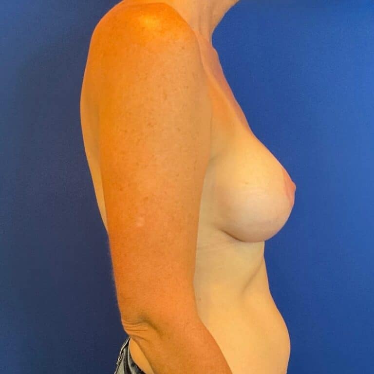 After Image: Patient Case #6863 - right-side