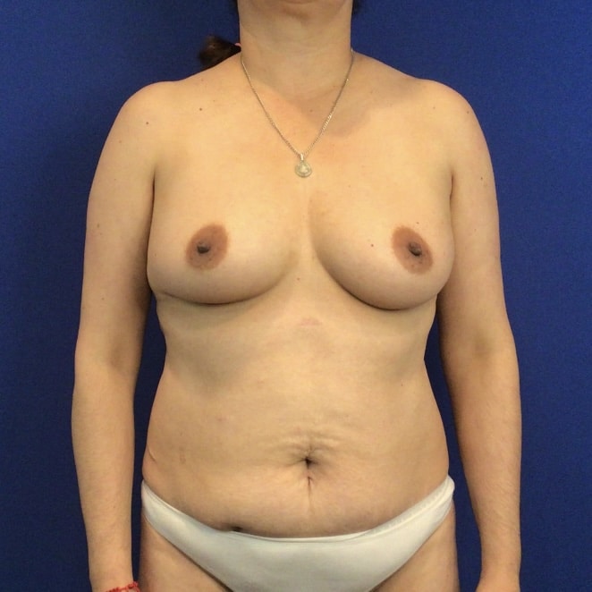 Before Image: Patient Case #6892 - front