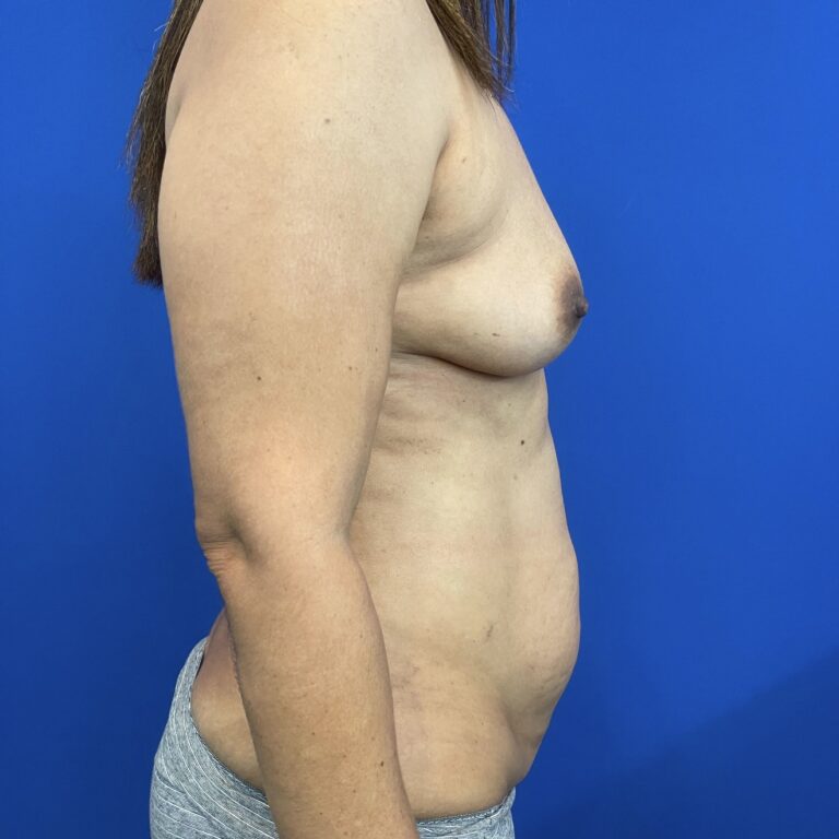 Before Image: Patient Case #6917 - right-side