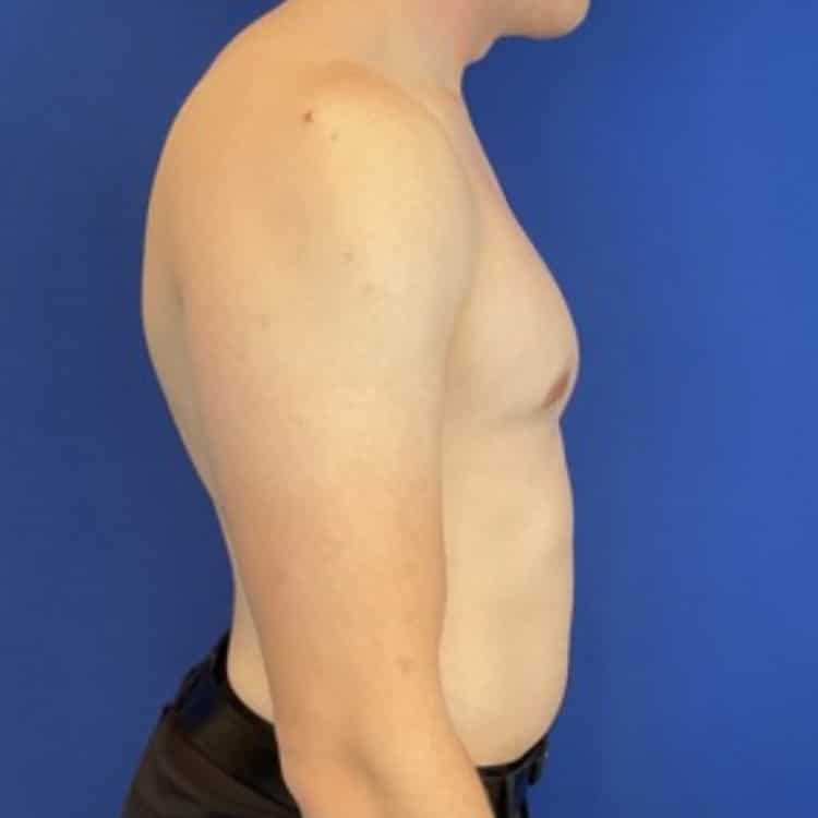 After Image: Patient Case #6936 - right-side