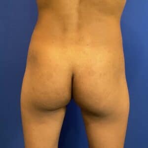 Before Image: Patient Case #6951