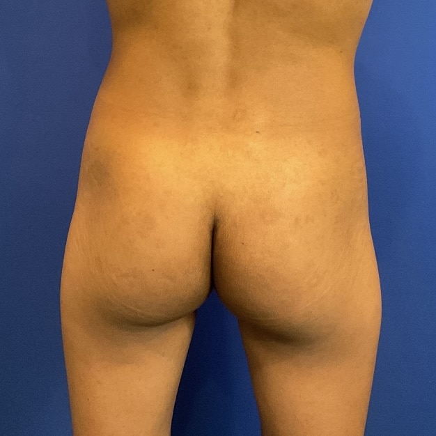Before Image: Patient Case #6951 - back