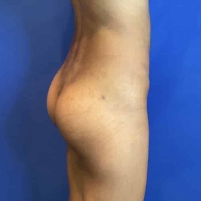 After Image: Patient Case #6951 - right-side