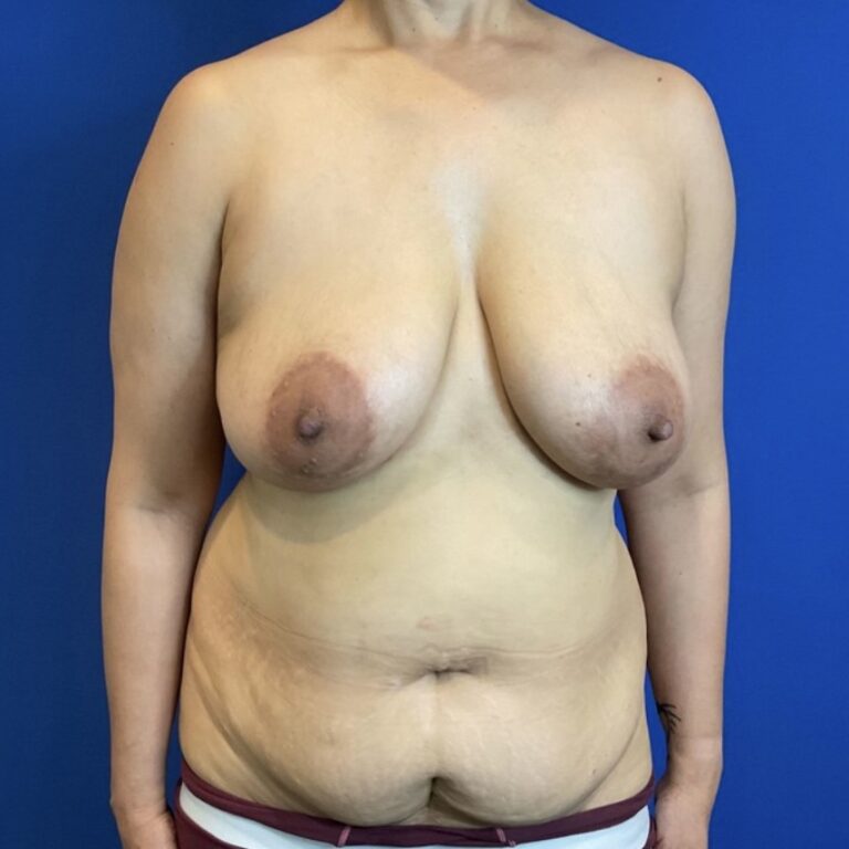 Before Image: Patient Case #6979 - front