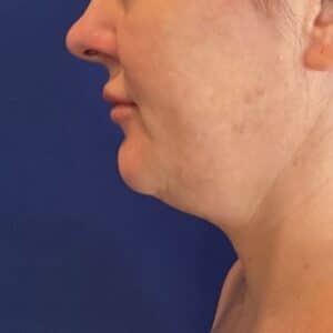 Before Image: Patient Case #7016