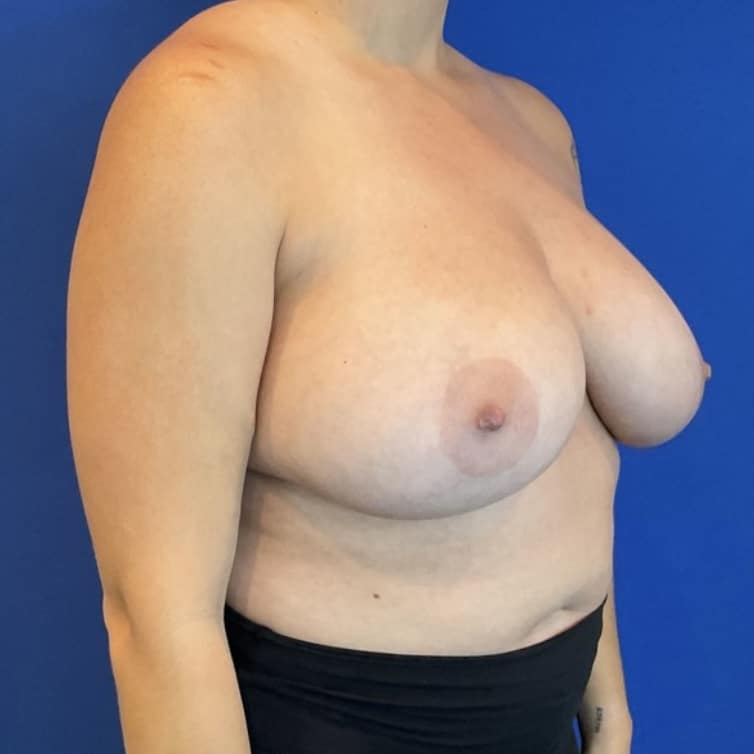 Before Image: Patient Case #7033 - right-front-oblique