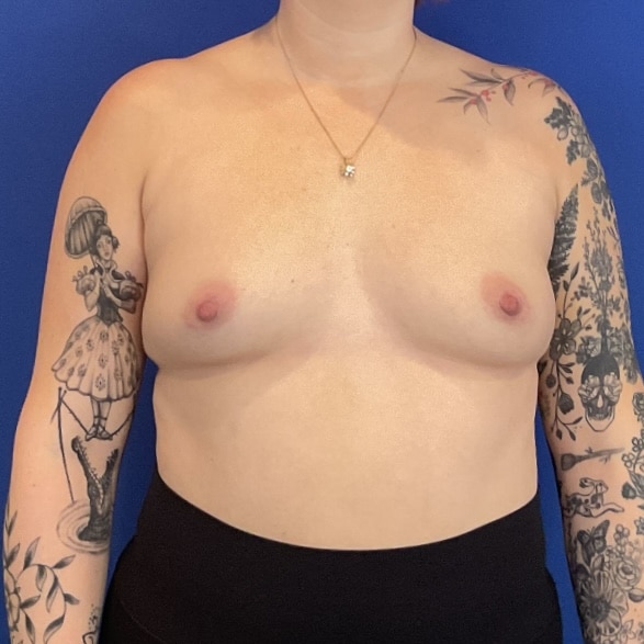 Before Image: Patient Case #7040 - front