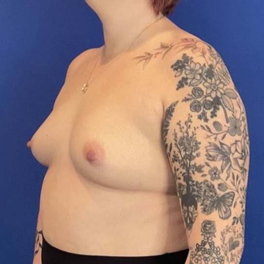 Before Image: Patient Case #7040 - left-front-oblique