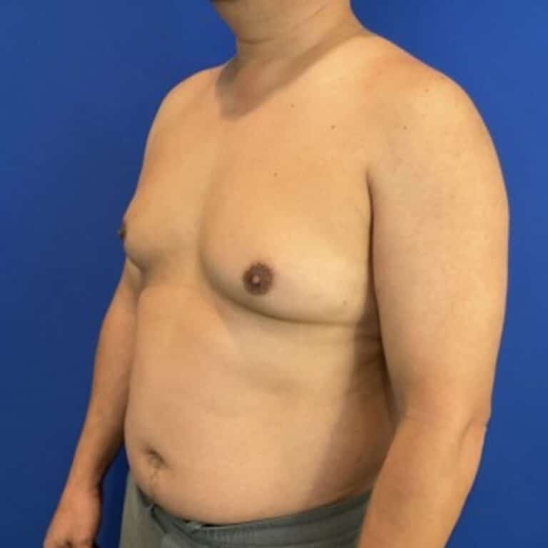 Before Image: Patient Case #7061 - left-front-oblique