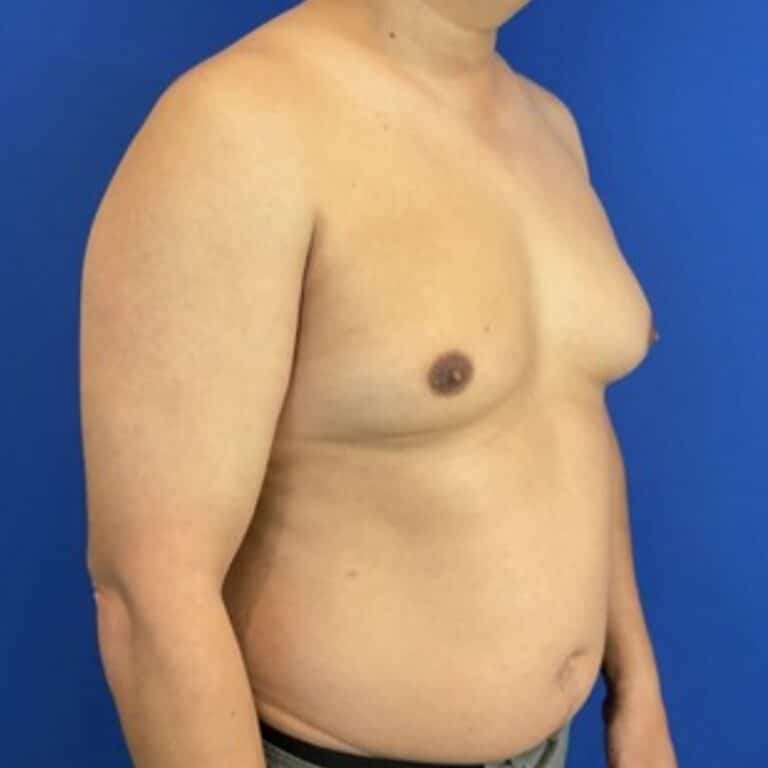 Before Image: Patient Case #7061 - right-front-oblique