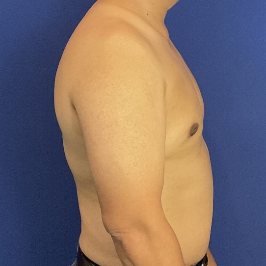 After Image: Patient Case #7061 - right-side