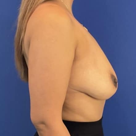 After Image: Patient Case #7078 - right-side