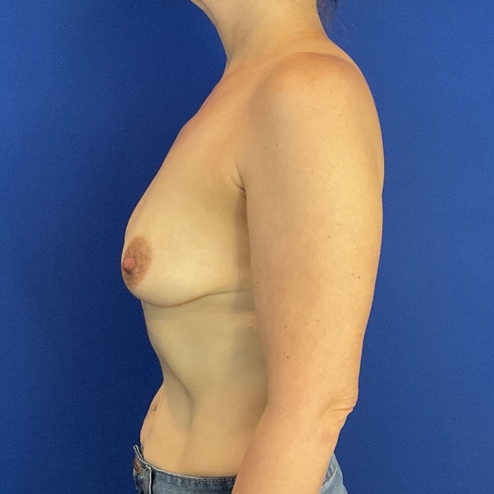 Before Image: Patient Case #7097 - left-side