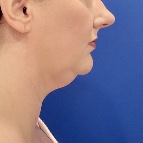 Before Image: Patient Case #7108 - right-side