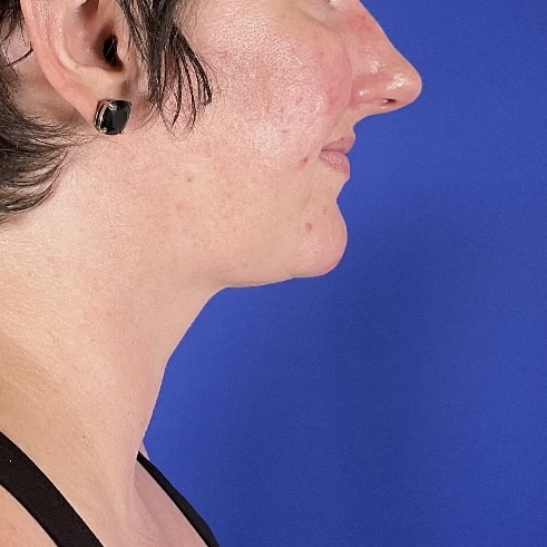 After Image: Patient Case #7108 - right-side