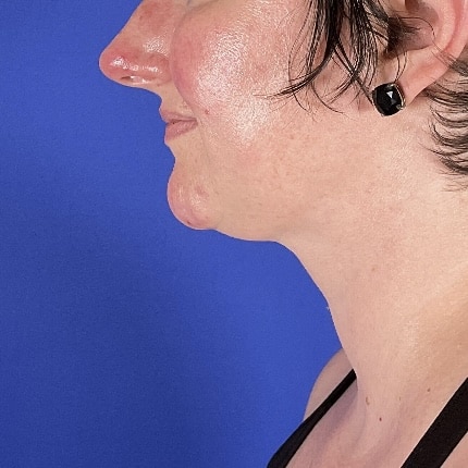 After Image: Patient Case #7108 - left-side