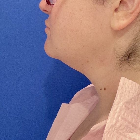 Before Image: Patient Case #7130 - left-side